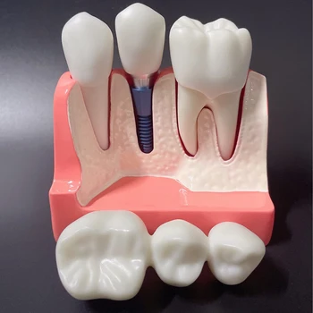 Модель зубного имплантата Для анализа Съемная Коронка Мостовидный Протез Демонстрационная Модель зубов Для Анализа Зубных имплантатов Модель зуба для обучения